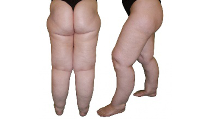 Lipedema