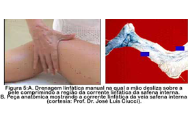 O passo a passo da técnica que revoluciona o tratamento do linfedema