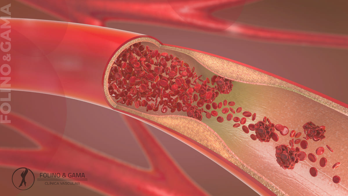 Doenças do Sistema Arterial